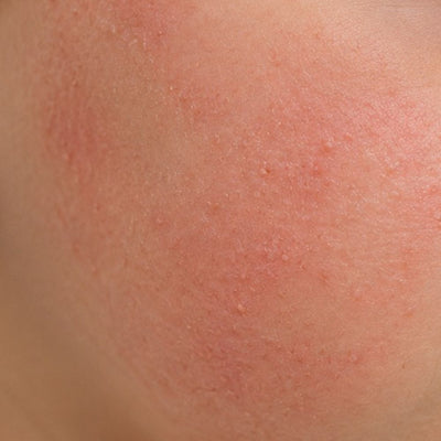 Comment différencier l’eczéma et la peau à tendance atopique chez l’enfant ?